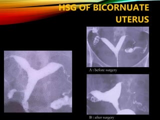 A : before surgery
B : after surgery
HSG OF BICORNUATE
UTERUS
 