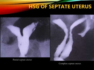 Partial septate uterus
Complete septate uterus
HSG OF SEPTATE UTERUS
 