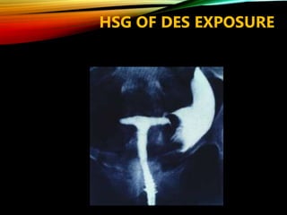 HSG OF DES EXPOSURE
 