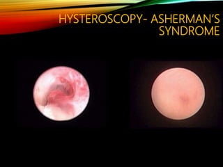 HYSTEROSCOPY- ASHERMAN’S
SYNDROME
 
