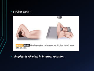 • Stryker view - 
• simplest is AP view in internal rotation. 
 