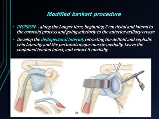 Modified bankart procedure 
• INCISION - along the Langer lines, beginning 2 cm distal and lateral to 
the coracoid process and going inferiorly to the anterior axillary crease 
• Develop the deltopectoral interval, retracting the deltoid and cephalic 
vein laterally and the pectoralis major muscle medially. Leave the 
conjoined tendon intact, and retract it medially 
 