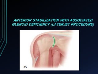 ANTERIOR STABILIZATION WITH ASSOCIATED 
GLENOID DEFICIENCY (LATERJET PROCEDURE) 
 