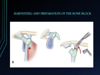 HARVESTING AND PREPARATION OF THE BONE BLOCK 
 