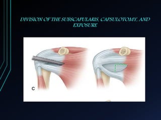 DIVISION OF THE SUBSCAPULARIS, CAPSULOTOMY, AND 
EXPOSURE 
 