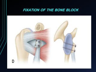 FIXATION OF THE BONE BLOCK 
 