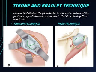 TIBONE AND BRADLEY TECHNIQUE 
• capsule is shifted on the glenoid side to reduce the volume of the 
posterior capsule in a manner similar to that described by Neer 
and Foster 
• TIBOLON TECHNIQUE NEER TECHNIQUE 
 