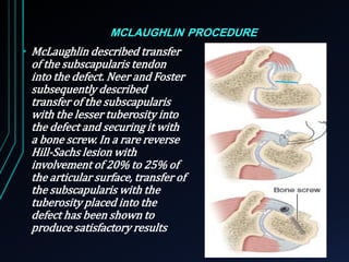 MCLAUGHLIN PROCEDURE 
• McLaughlin described transfer 
of the subscapularis tendon 
into the defect. Neer and Foster 
subsequently described 
transfer of the subscapularis 
with the lesser tuberosity into 
the defect and securing it with 
a bone screw. In a rare reverse 
Hill-Sachs lesion with 
involvement of 20% to 25% of 
the articular surface, transfer of 
the subscapularis with the 
tuberosity placed into the 
defect has been shown to 
produce satisfactory results 
 