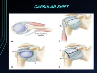 CAPSULAR SHIFT 
 