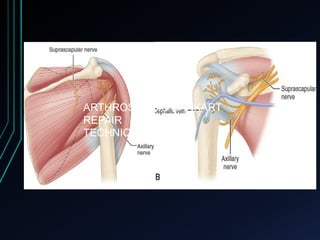 ARTHROSCOPIC BANKART 
REPAIR 
TECHNIQUE 
 