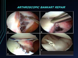 ARTHROSCOPIC BANKART REPAIR 
 