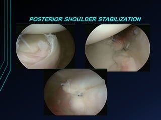 POSTERIOR SHOULDER STABILIZATION 
 