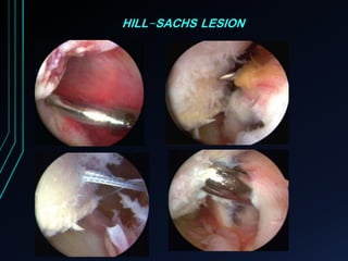 HILL-SACHS LESION 
 