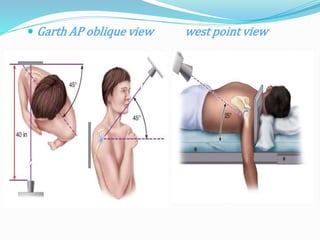  Garth AP oblique view west point view
 