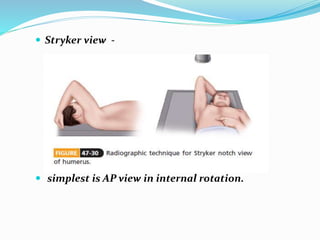  Stryker view -
 simplest is AP view in internal rotation.
 