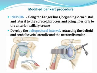 Modified bankart procedure
 INCISION - along the Langer lines, beginning 2 cm distal
and lateral to the coracoid process and going inferiorly to
the anterior axillary crease
 Develop the deltopectoral interval, retracting the deltoid
and cephalic vein laterally and the pectoralis major
muscle medially. Leave the conjoined tendon intact, and
retract it medially
 