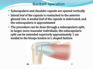 Bankart operation
 Subscapularis and shoulder capsule are opened vertically
 lateral leaf of the capsule is reattached to the anterior
glenoid rim. A medial leaf of the capsule is imbricated, and
the subscapularis is approximated
 The procedure can be done through a subscapularis split,
in larger, more muscular individuals, the subscapularis
split can be extended superiorly approximately 1 cm
medial to the biceps tendon in L shaped fashion
 