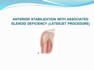 ANTERIOR STABILIZATION WITH ASSOCIATED
GLENOID DEFICIENCY (LATERJET PROCEDURE)
 