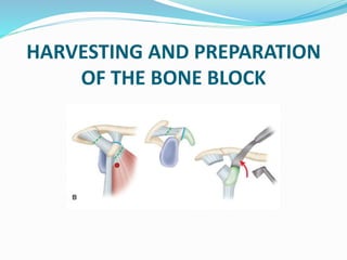 HARVESTING AND PREPARATION
OF THE BONE BLOCK
 