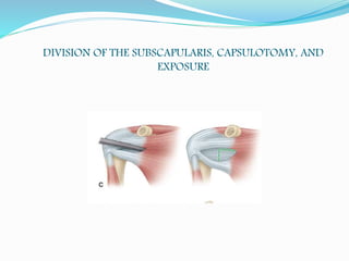 DIVISION OF THE SUBSCAPULARIS, CAPSULOTOMY, AND
EXPOSURE
 