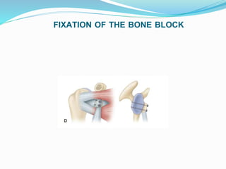 FIXATION OF THE BONE BLOCK
 