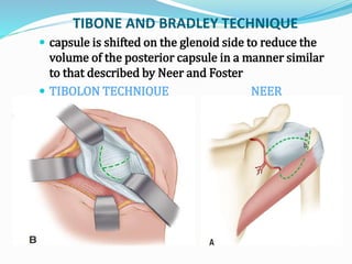 TIBONE AND BRADLEY TECHNIQUE
 capsule is shifted on the glenoid side to reduce the
volume of the posterior capsule in a manner similar
to that described by Neer and Foster
 TIBOLON TECHNIQUE NEER
TECHNIQUE
 