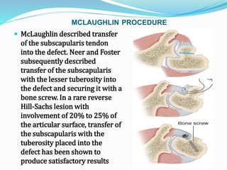 MCLAUGHLIN PROCEDURE
 McLaughlin described transfer
of the subscapularis tendon
into the defect. Neer and Foster
subsequently described
transfer of the subscapularis
with the lesser tuberosity into
the defect and securing it with a
bone screw. In a rare reverse
Hill-Sachs lesion with
involvement of 20% to 25% of
the articular surface, transfer of
the subscapularis with the
tuberosity placed into the
defect has been shown to
produce satisfactory results
 