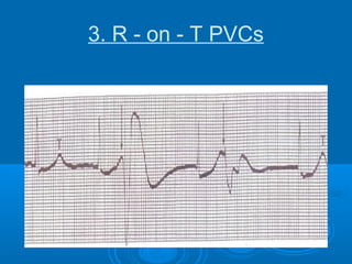 Recurrent Vvc Recurrent ventricular arrhythmia after cardiac surgery | PPT
