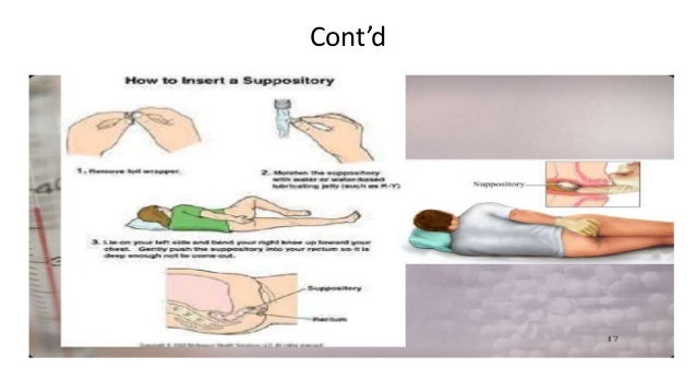 how to use dulcolax rectal suppository