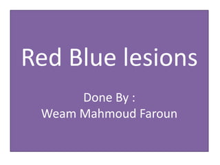 Red Blue lesions
Done By :
Weam Mahmoud Faroun
 