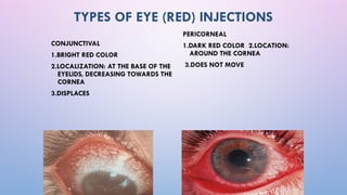 Comprehensive Overview of Red Eye Syndrome: Causes, Symptoms, and ...