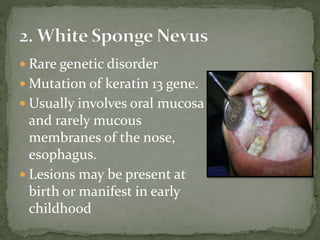  Rare genetic disorder
 Mutation of keratin 13 gene.
 Usually involves oral mucosa
and rarely mucous
membranes of the nose,
esophagus.
 Lesions may be present at
birth or manifest in early
childhood
 