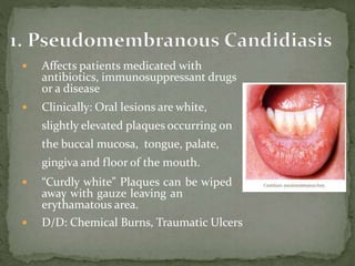  Affects patients medicated with
antibiotics, immunosuppressant drugs
or a disease
 Clinically: Oral lesions are white,
slightly elevated plaques occurring on
the buccal mucosa, tongue, palate,
gingiva and floor of the mouth.
 “Curdly white” Plaques can be wiped
away with gauze leaving an
erythamatous area.
 D/D: Chemical Burns, Traumatic Ulcers
 