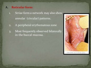 A. Reticular form:
1. Striae form a network may also show
annular (circular) patterns.
2. A peripheral erythematous zone
3. Most frequently observed bilaterally
in the buccal mucosa.
 