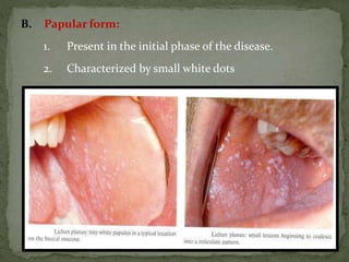 B. Papular form:
1. Present in the initial phase of the disease.
2. Characterized by small white dots
 