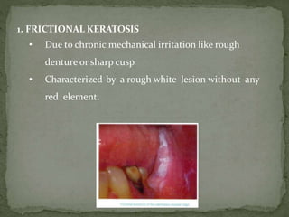 1. FRICTIONAL KERATOSIS
• Due to chronic mechanical irritation like rough
denture or sharp cusp
• Characterized by a rough white lesion without any
red element.
 