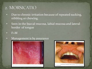 • Due to chronic irritation because of repeated sucking,
nibbling or chewing.
• Seen in the buccal mucosa, labial mucosa and lateral
border of tongue
• F>M
• Management is by assurance
 