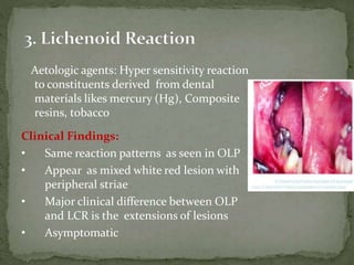 Aetologic agents: Hyper sensitivity reaction
to constituents derived from dental
materials likes mercury (Hg), Composite
resins, tobacco
Clinical Findings:
• Same reaction patterns as seen in OLP
• Appear as mixed white red lesion with
peripheral striae
• Major clinical difference between OLP
and LCR is the extensions of lesions
• Asymptomatic
 