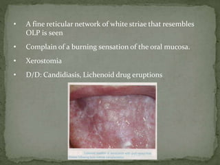 • A fine reticular network of white striae that resembles
OLP is seen
• Complain of a burning sensation of the oral mucosa.
• Xerostomia
• D/D: Candidiasis, Lichenoid drug eruptions
 