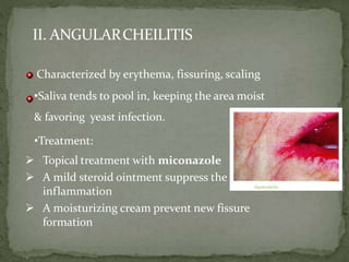 Characterized by erythema, fissuring, scaling
•Saliva tends to pool in, keeping the area moist
& favoring yeast infection.
•Treatment:
 Topical treatment with miconazole
 A mild steroid ointment suppress the
inflammation
 A moisturizing cream prevent new fissure
formation
II. ANGULARCHEILITIS
 