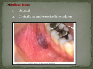 D)Bullous form:
1. Unusual
2. Clinically resemble erosive lichen planus
 