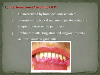 E) Erythematous (Atrophic) OLP:
1. Characterized by homogeneous red area
2. Present in the buccal mucosa or palate, striae are
frequently seen in the periphery
3. Exclusively affecting attached gingiva presents
as desquamative gingivitis.
 