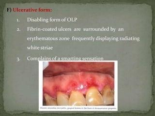 F) Ulcerative form:
1. Disabling form of OLP
2. Fibrin-coated ulcers are surrounded by an
erythematous zone frequently displaying radiating
white striae
3. Complains of a smarting sensation
 