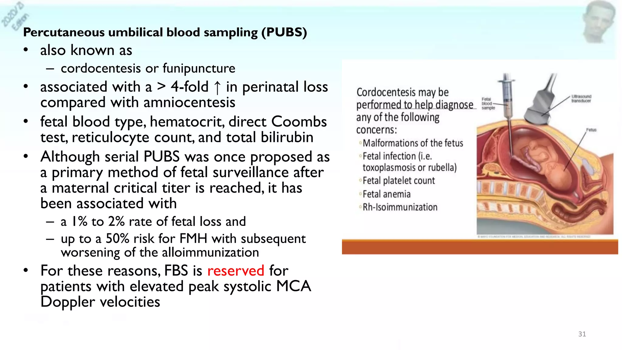 Percutaneous umbilical blood sampling (PUBS)
• also known as
– cordocentesis or funipuncture
• associated with a > 4-fold ↑ in perinatal loss
compared with amniocentesis
• fetal blood type, hematocrit, direct Coombs
test, reticulocyte count, and total bilirubin
• Although serial PUBS was once proposed as
a primary method of fetal surveillance after
a maternal critical titer is reached, it has
been associated with
– a 1% to 2% rate of fetal loss and
– up to a 50% risk for FMH with subsequent
worsening of the alloimmunization
• For these reasons, FBS is reserved for
patients with elevated peak systolic MCA
Doppler velocities
31
 