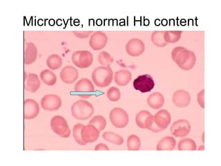 Normal Rbc En Micras Red blood Cells Morphology detailed .ppt
