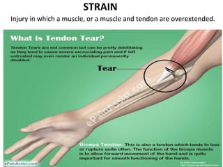 STRAIN
Injury in which a muscle, or a muscle and tendon are overextended.
 