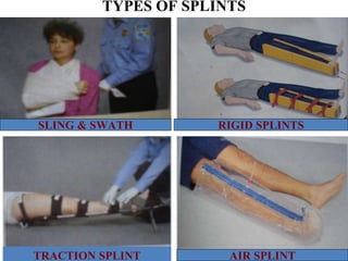 TYPES OF SPLINTS
TRACTION SPLINT
SLING & SWATH RIGID SPLINTS
AIR SPLINT
 