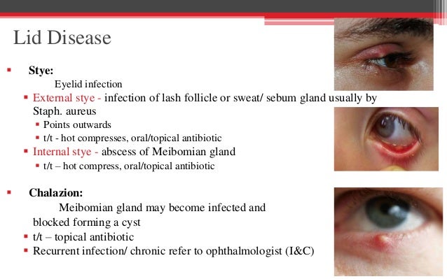Hordeolo Internal Vs External Hordeolum