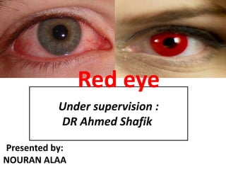 Under supervision :
DR Ahmed Shafik
Red eye
Presented by:
NOURAN ALAA
 