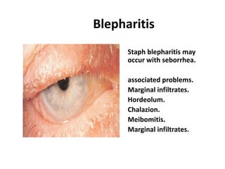 Marginal Infiltrates Red eye syndrome | PPSX